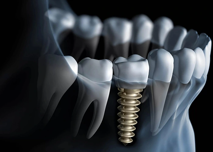 ایمپلنت فوری