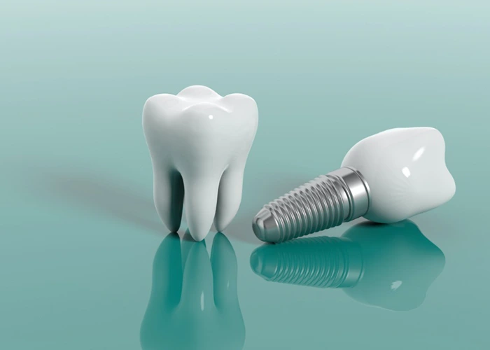 چه کسانی کاندید مناسب ایمپلنت فوری در شهر قدس هستند؟