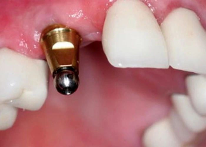 ایمپلنت فوری چیست و چه تفاوتی با ایمپلنت معمولی دارد؟