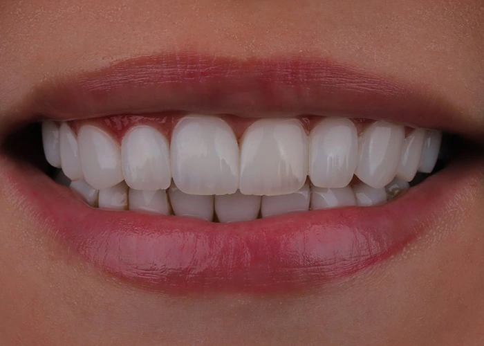 طول عمر ایمپلنت