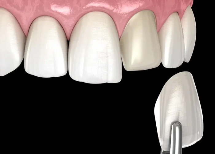 طول عمر ایمپلنت