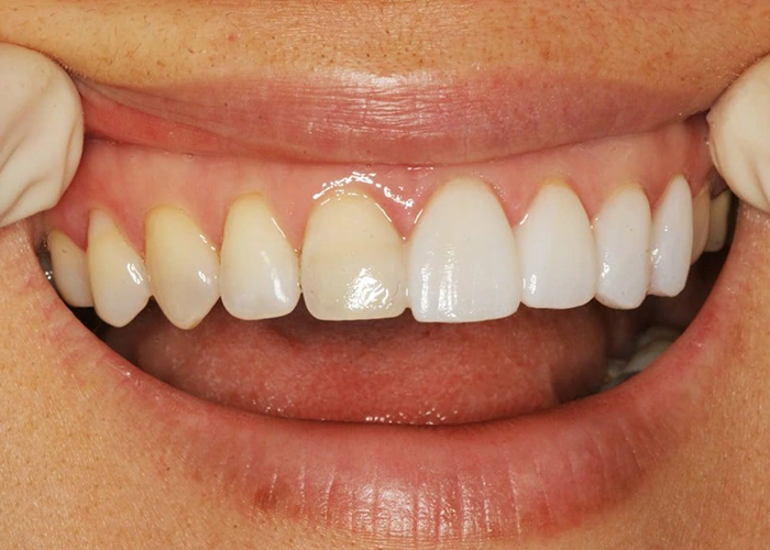 دوام کامپوزیتها