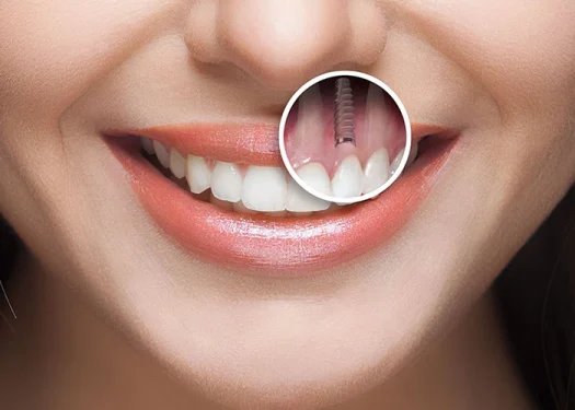 مراقبتهای بعد از ایمپلنت و کامپوزیت؛ راهنمای بیماران شهر قدس