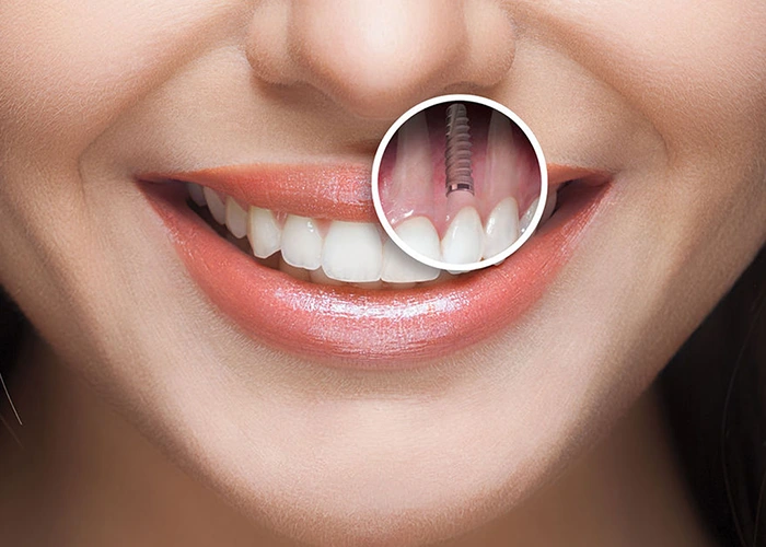 مراقبت‌های بعد از ایمپلنت و کامپوزیت؛ راهنمای بیماران شهر قدس