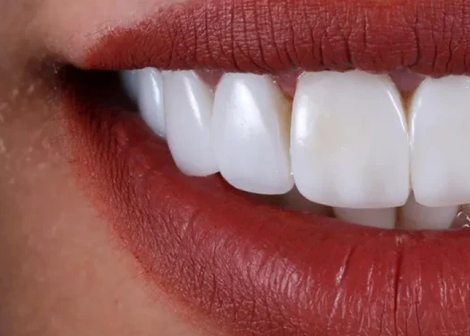 آیا کامپوزیت باعث پوسیدگی دندان میشود؟ بررسی و نکات مهم