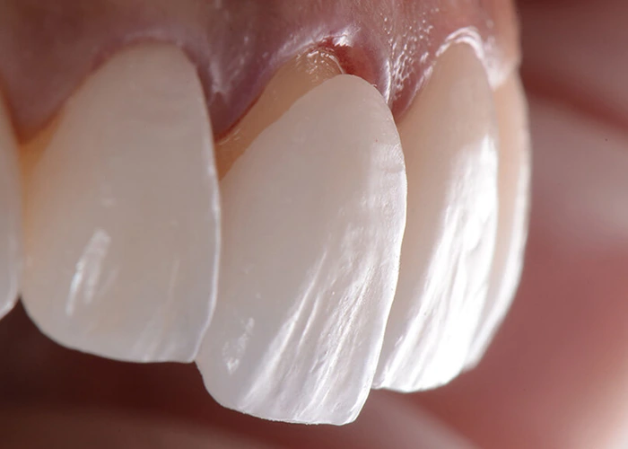 چطور بهترین دندانپزشک برای کامپوزیت را انتخاب کنیم؟