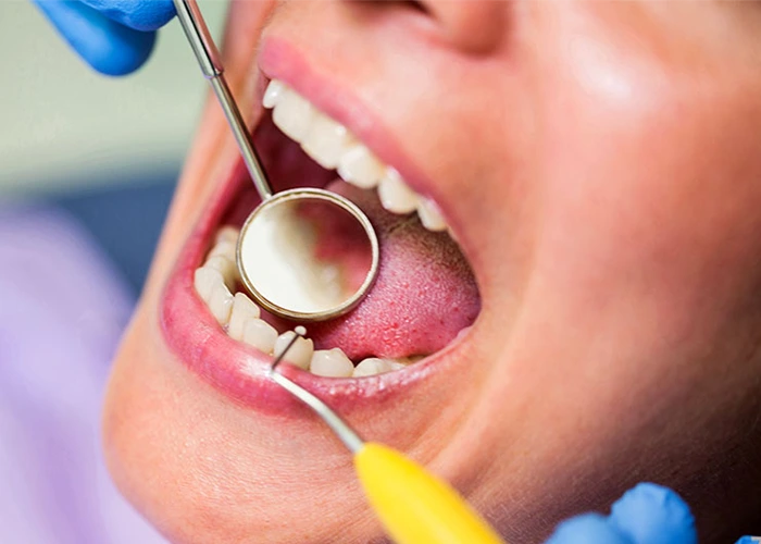 لیست نشانههایی که ممکن است دندان زیر کامپوزیت پوسیده باشد: