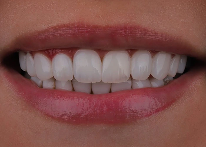 تفاوت بین پوسیدگی طبیعی و پوسیدگی ناشی از کامپوزیت