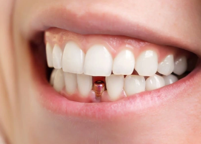 تفاوت درد ایمپلنت با سایر درمانهای دندانپزشکی