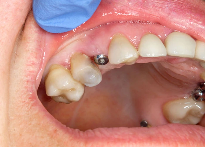 سوالات متداول
هزینه ایمپلنت دندان در شهر قدس چقدر است؟
هزینه ایمپلنت بستگی به نوع ایمپلنت، تعداد دندانها، تخصص دندانپزشک و کلینیک دارد. معمولاً از ۱۰ تا ۳۰ میلیون تومان متغیر است.
آیا ایمپلنت دردناک است؟
در زمان کاشت ایمپلنت با بیحسی موضعی درد حس نمیکنید، و درد پس از عمل با داروهای مسکن قابل کنترل است.
چه مدت زمان برای انجام کامل ایمپلنت نیاز است؟
معمولاً ۳ تا ۶ ماه از کاشت پایه تا نصب تاج زمان لازم است.