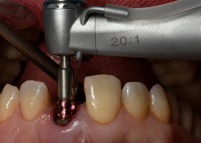 مزایای انجام ایمپلنت دندان در شهر قدس