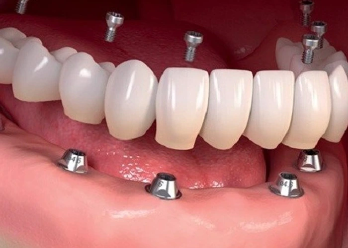 نکات مهم در انجام ایمپلنت دندان در شهر قدس