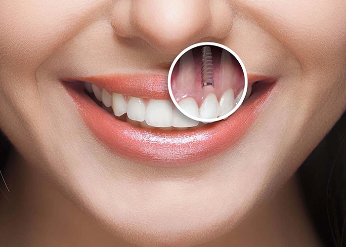 مراحل انجام ایمپلنت دندان در شهر قدس