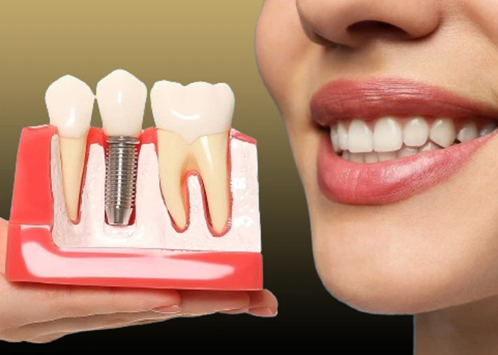 ایمپلنت دندان چیست؟