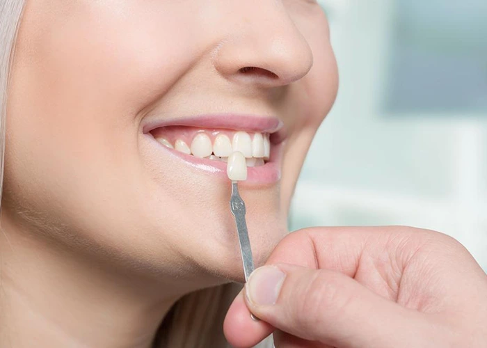 مراقبتهای بعد از انجام کامپوزیت برای جلوگیری از پوسیدگی