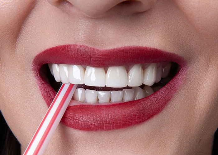 راههای پیشگیری از پوسیدگی دندان بعد از کامپوزیت