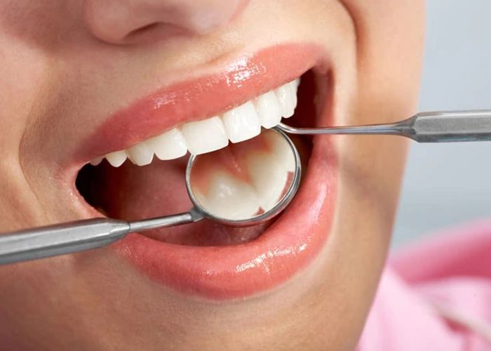 آیا کامپوزیت دندان باعث پوسیدگی میشود؟